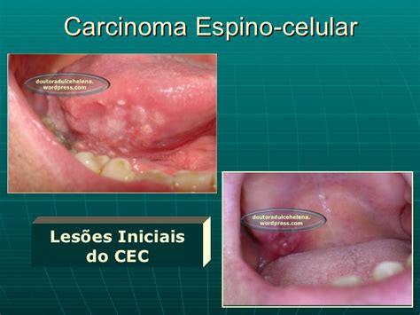 Carcinoma Epidermóide