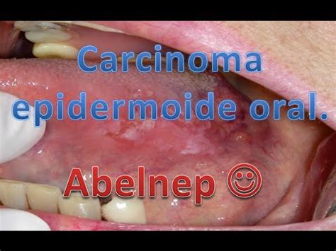 Carcinoma epidermoide oral  El cancer letal  | Abelnep ...