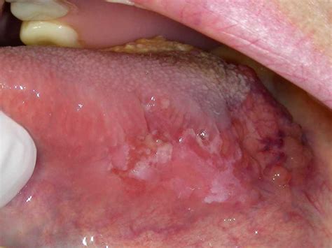 Carcinoma epidermoide oral  El cancer letal    Ciencia y ...
