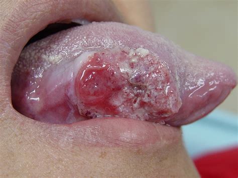 Carcinoma epidermoide oral  El cancer letal    Ciencia y ...