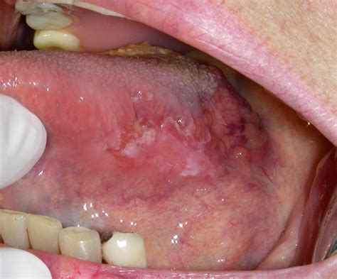 Carcinoma epidermoide oral  El cancer letal    Taringa!