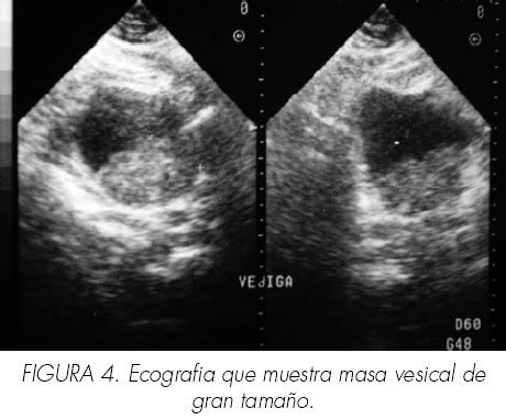 Carcinoma epidermoide vesical: Revisión de nuestra serie