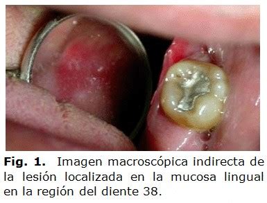 Carcinoma escamocelular bucal diagnosticado precozmente