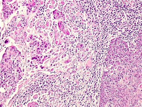 Carcinoma Escamocelular Invasivo | Eurocytology