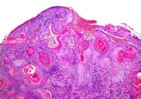 Carcinoma espinocelular de la vulva: caso clínico