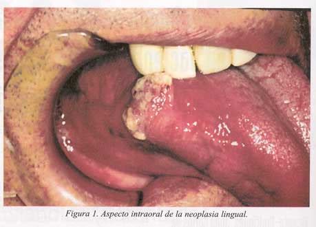 Carcinoma Espinocelular Lengua