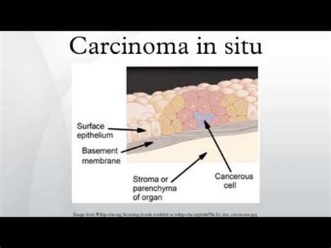 Carcinoma in situ   YouTube