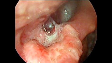 Carcinoma laringe   YouTube