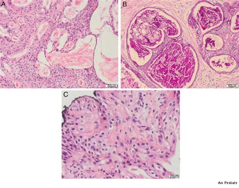 Carcinoma mucoepidermoide de glándula parótida | Anales de Pediatría