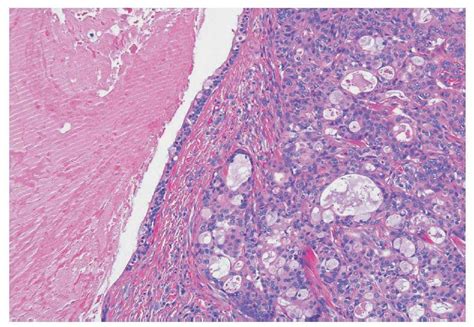 Carcinoma mucoepidermoide de una glándula salival menor | Quintessence