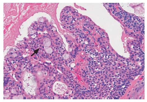 Carcinoma mucoepidermoide de una glándula salival menor | Quintessence