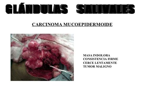 CARCINOMA MUCOEPIDERMOIDE GLANDULAS SALIVALES PDF
