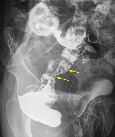 Carcinoma of rectum | Image | Radiopaedia.org