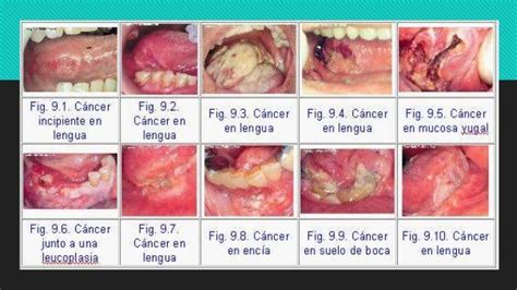Carcinoma Oral De Celulas Escamosas   SEO POSITIVO