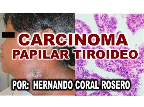 CARCINOMA PAPILAR TIROIDEO   CANCER CELULAR DE TIROIDES ...