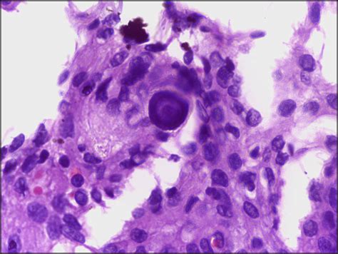 Carcinoma papilar tiroides, Părăseşte Website