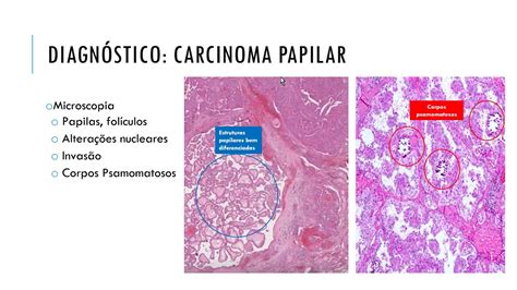 Carcinoma papilar tiroides, Părăseşte Website