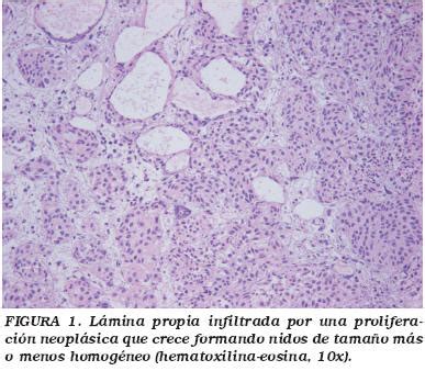 Carcinoma urotelial de vejiga tipo Nested: Una variante ...