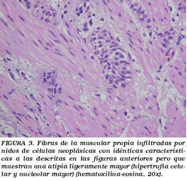 Carcinoma urotelial de vejiga tipo Nested: Una variante ...