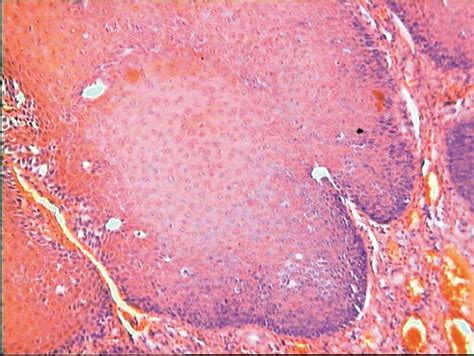 Carcinoma verrucoso de vulva | Clínica e Investigación en ...