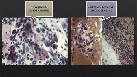 Carcinoma Vs Adenocarcinoma en 2020 | Uterina, Planos, Cuello uterino