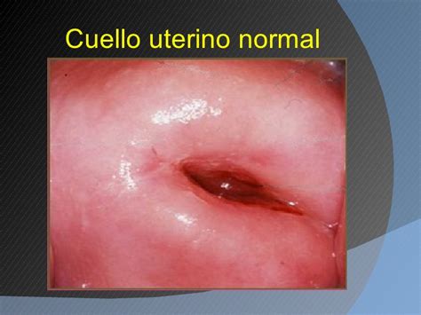 Carcinomas de cuello uterino y endometrio