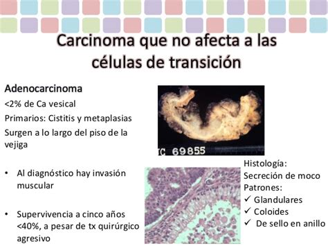 Carcinomas Vesicales