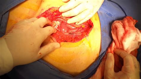 Carcinomatósis en tumor maligno de Ovario   YouTube