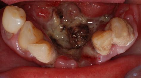 Carcinome du plancher de la bouche   DocCheck Pictures