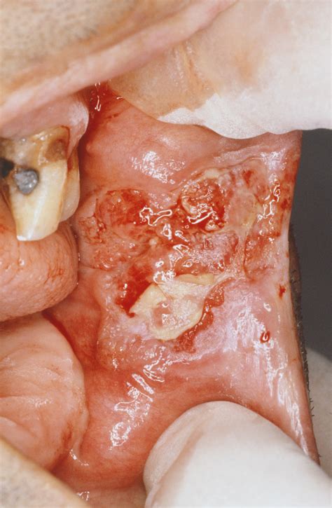 Carcinome malpighien de la cavité orale   Affections de l ...