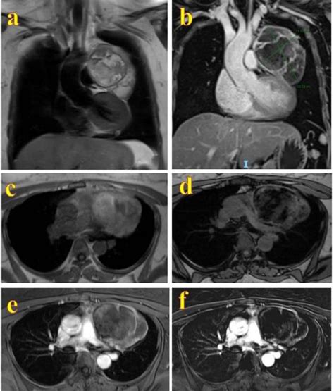 Case 2  Mediastinal mature cystic teratoma in a 35 year old woman ...