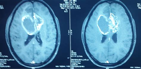 Case Study | Malignant Brain Tumor Removal | Neurosurgery ...