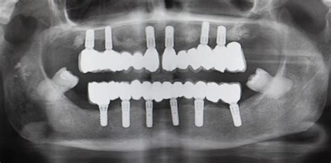 Caso 03: Paciente con enfermedad periodontal   Clinica Dental Patins