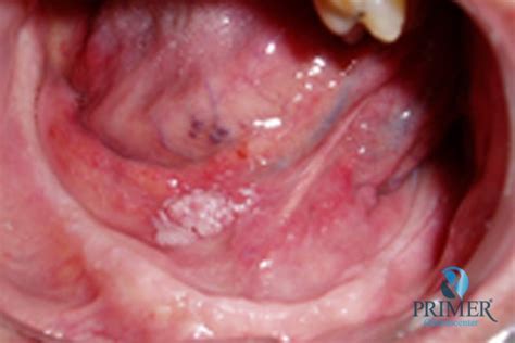 Caso clínico – Câncer bucal  Carcinoma Espinocelular ...