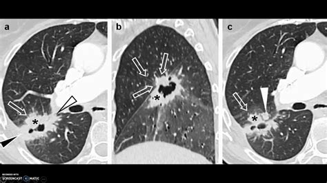 Caso clínico Tumor maligno de pulmón   YouTube