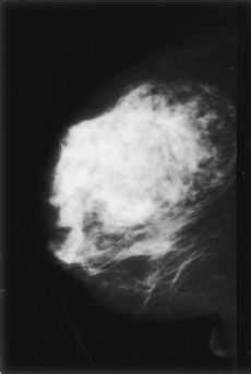 Casos clínicos Carcinoma lobulillar en un hamartoma mamario: a ...