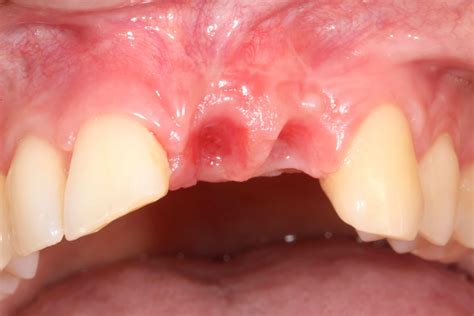 Casos clínicos: Cirugía bucal   Clínica Dental Gemma Farré
