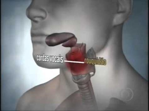 CAT_ Câncer de laringe   Dr. Fernando Dias   YouTube