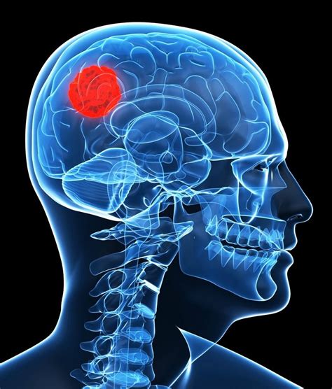 Causas de un tumor en el cerebro: Todo lo que debes saber