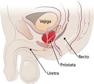 Causas, Síntomas y Remedios Para la Próstata Inflamada