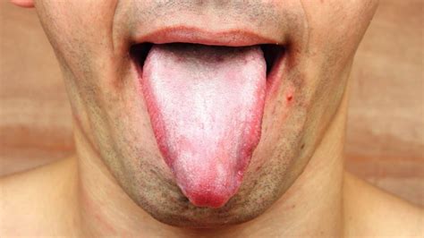 causas y cómo curar rápido y fácil las llagas en la lengua