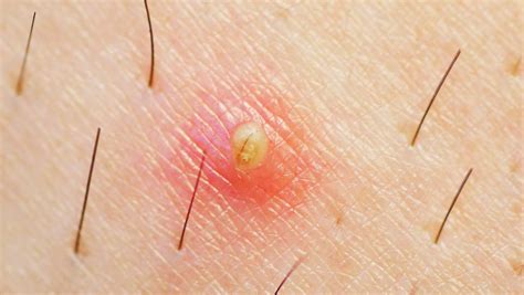 Causes and 8 Remedies of Ingrown Hair Bumps | New Health ...