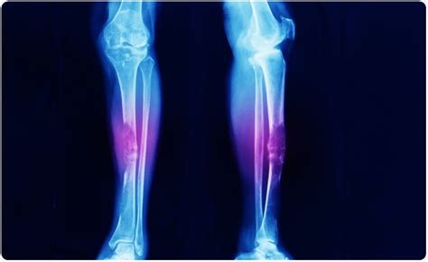 Causes and Symptoms of Bone Cancer