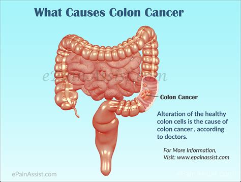 Causes and Symptoms of Colon Cancer or Cancer of the Colon