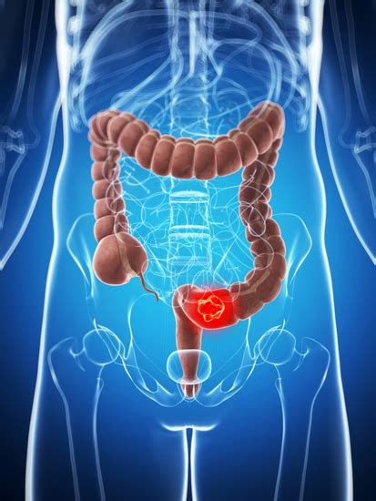 Causes And Symptoms Of Colon Cancer | Styles At Life