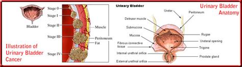 Causes and Symptoms of Urinary Bladder Cancer | Cancer ...