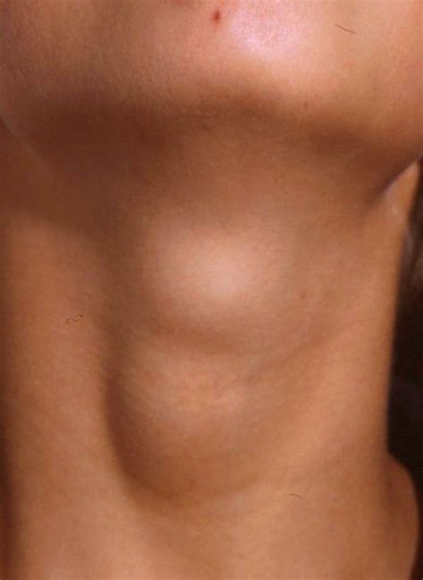 Causes and Treatments of Lumps: Neck, Armpit, Wrist, & More | HealDove