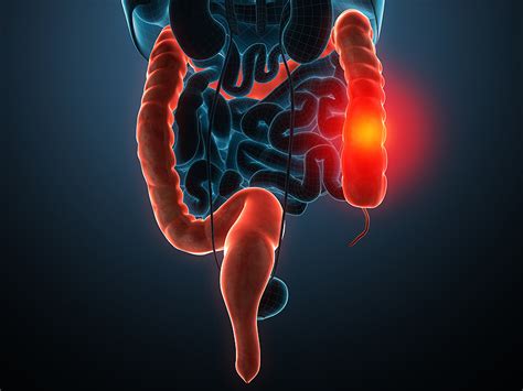 Causes of Colon Cancer   10 Risk Factors of Colon Cancer