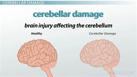 Cerebellar Damage: Symptoms & Treatment   Video & Lesson ...