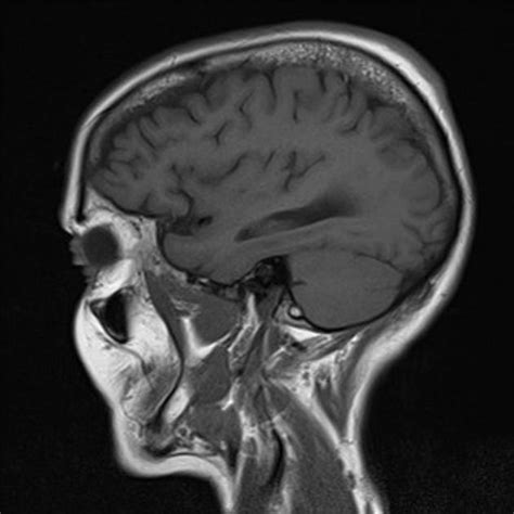 Cerebellar metastases | Radiology Case | Radiopaedia.org